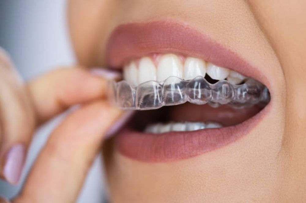 How Clear Aligners Can Improve Your Smile Discreetly