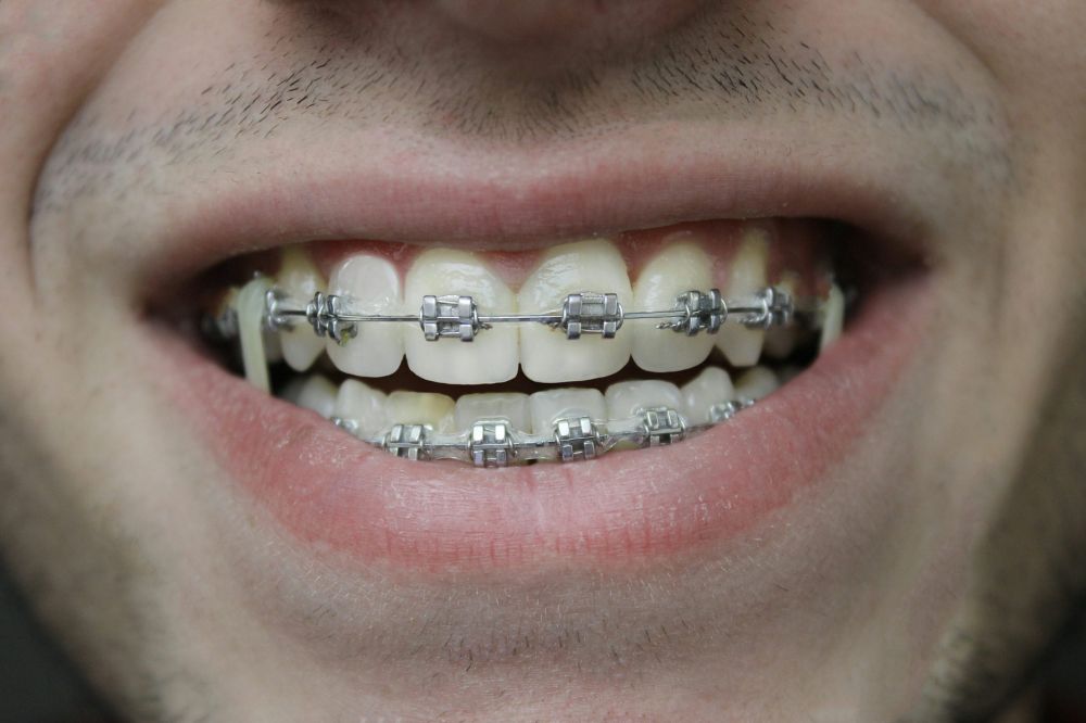 lightforce braces more comfortable than traditional braces